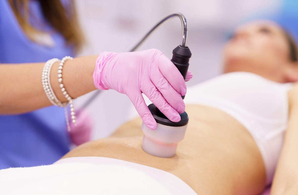 Από 14,90€: Μείωση Κυτταρίτιδας με RF και Cavitation | Καλλιθέα